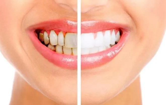 28059 professional teeth whitening