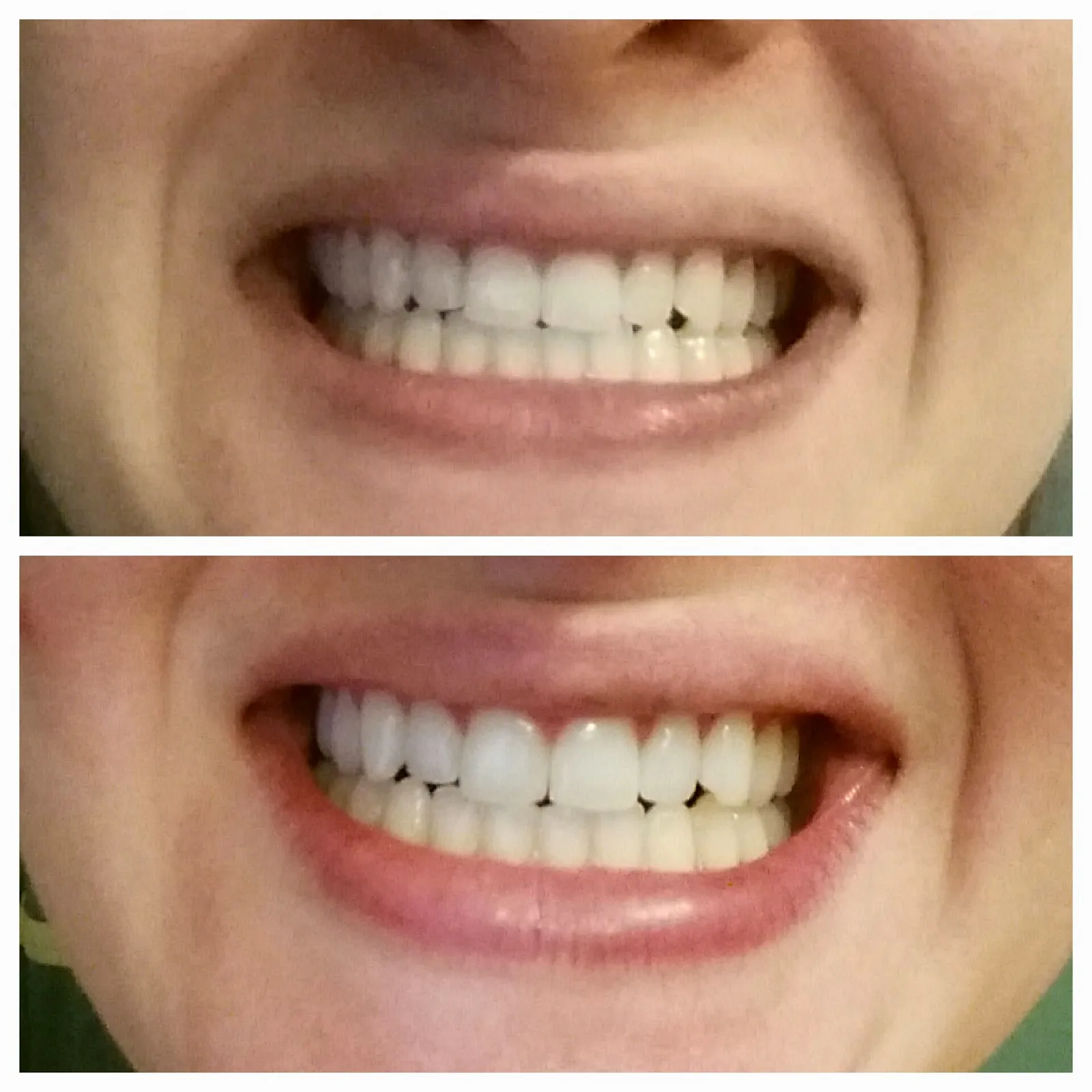 28061 teeth whitening powder sensitivity