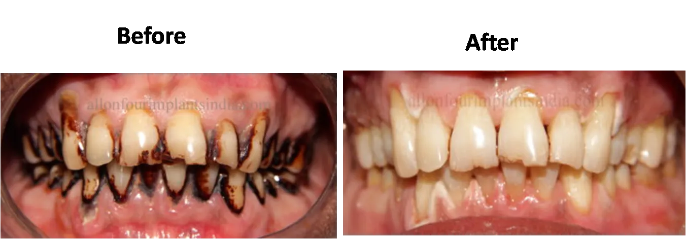 28070 teeth whitening sessions