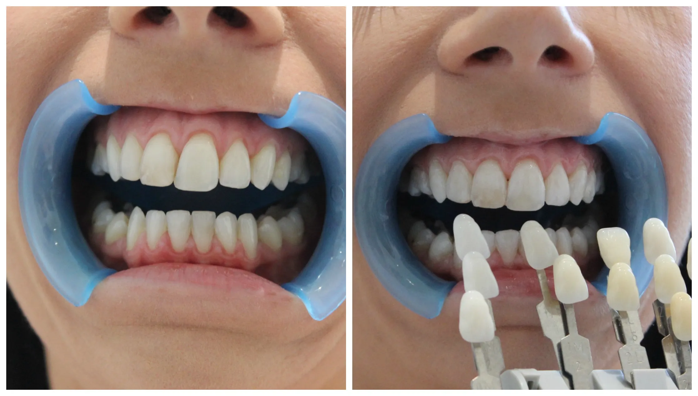 28075 teeth whitening results