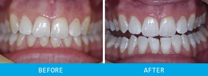 28092 teeth whitening results