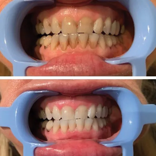 28093 teeth whitening eugene 5