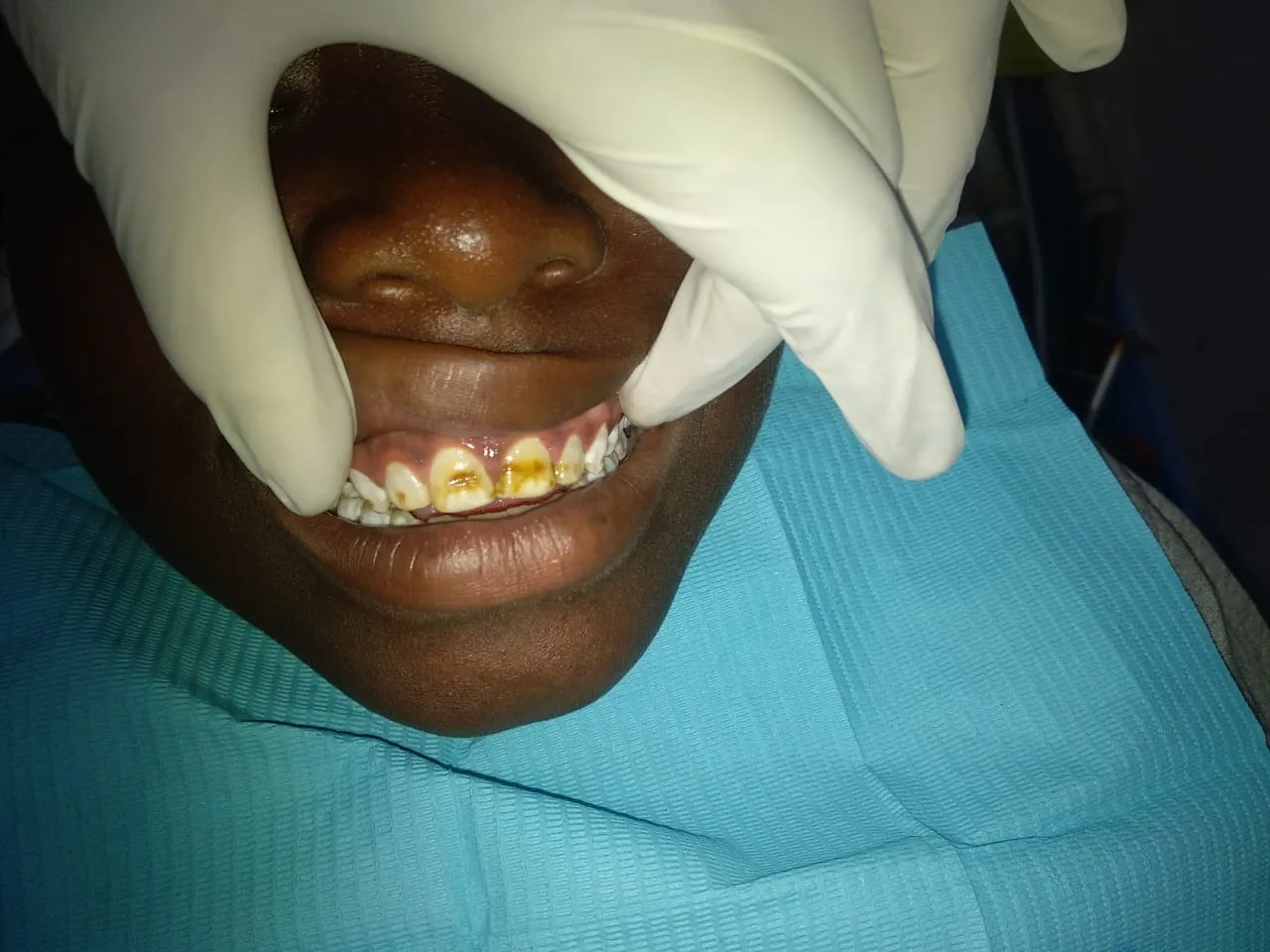 28094 teeth whitening ni aftercare