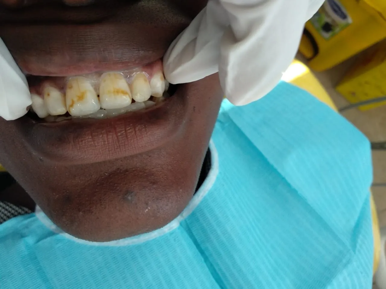 28094 teeth whitening ni gel application