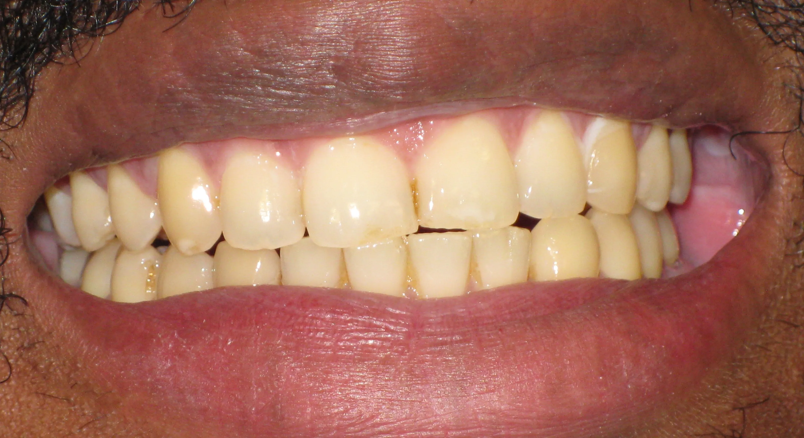 28094 teeth whitening ni professional vs diy