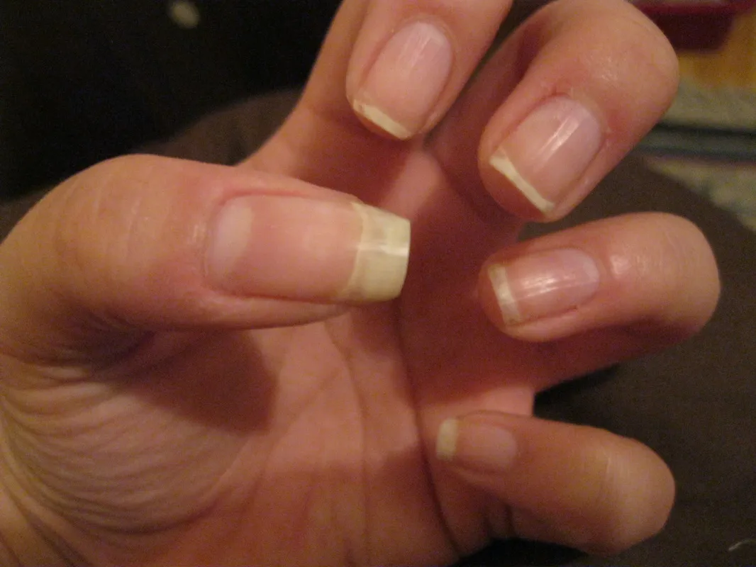 28099 nail whitening overview