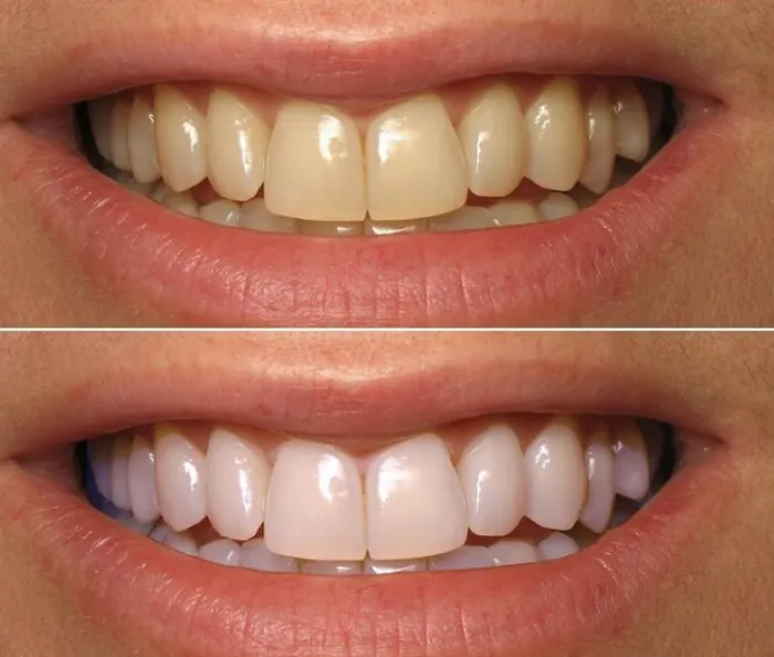 28103 removing whitening strips
