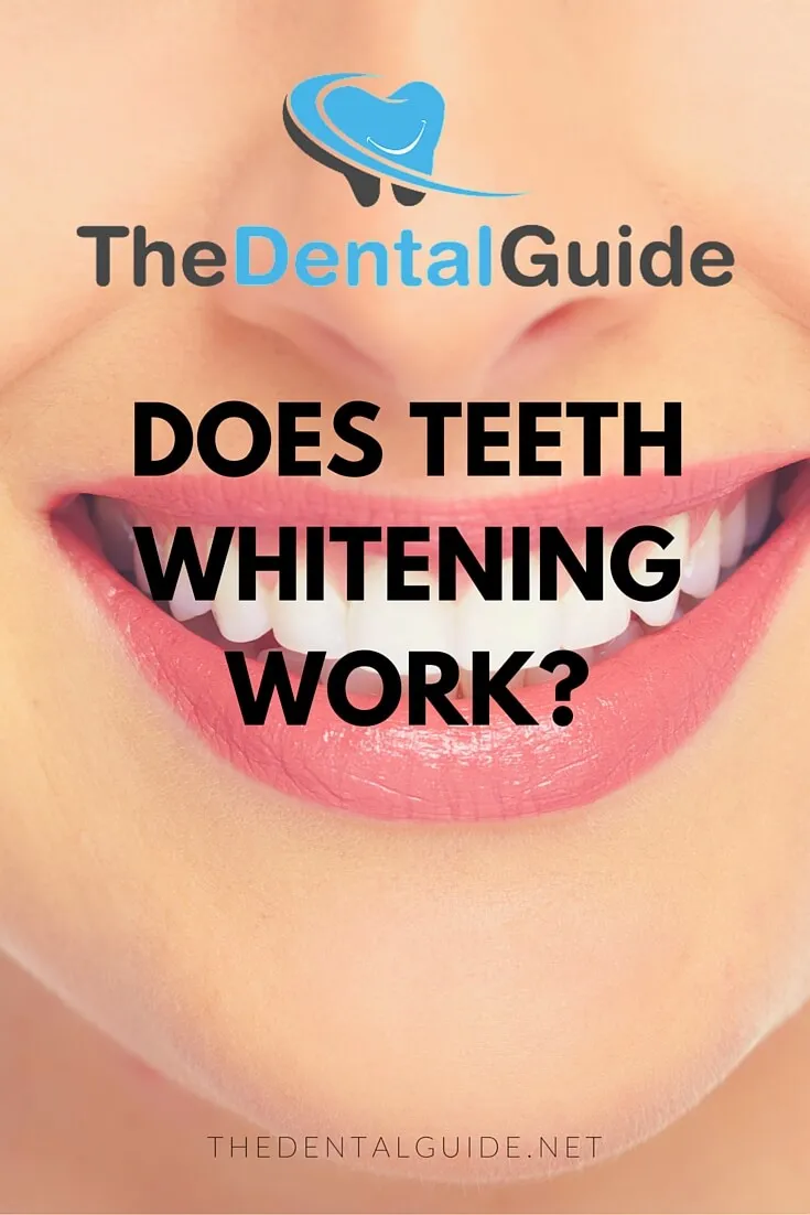 28107 in office teeth whitening