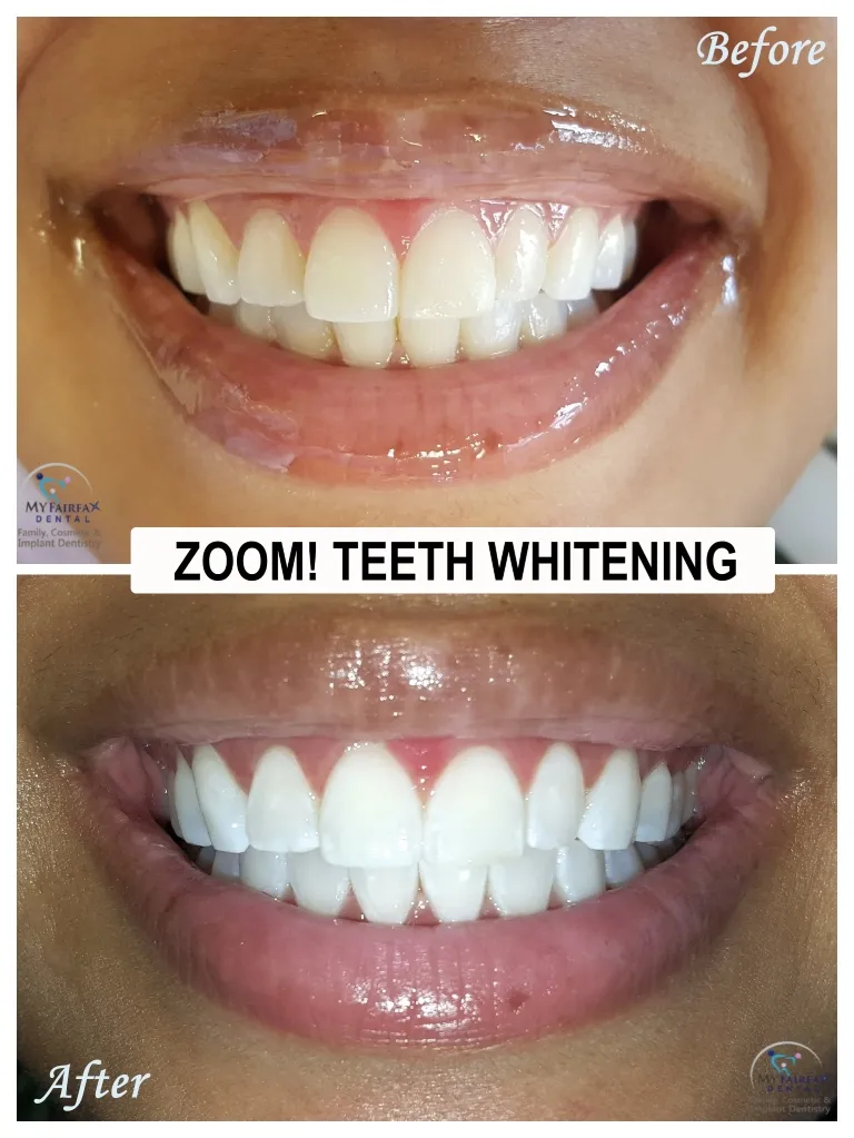 28107 teeth whitening dentist