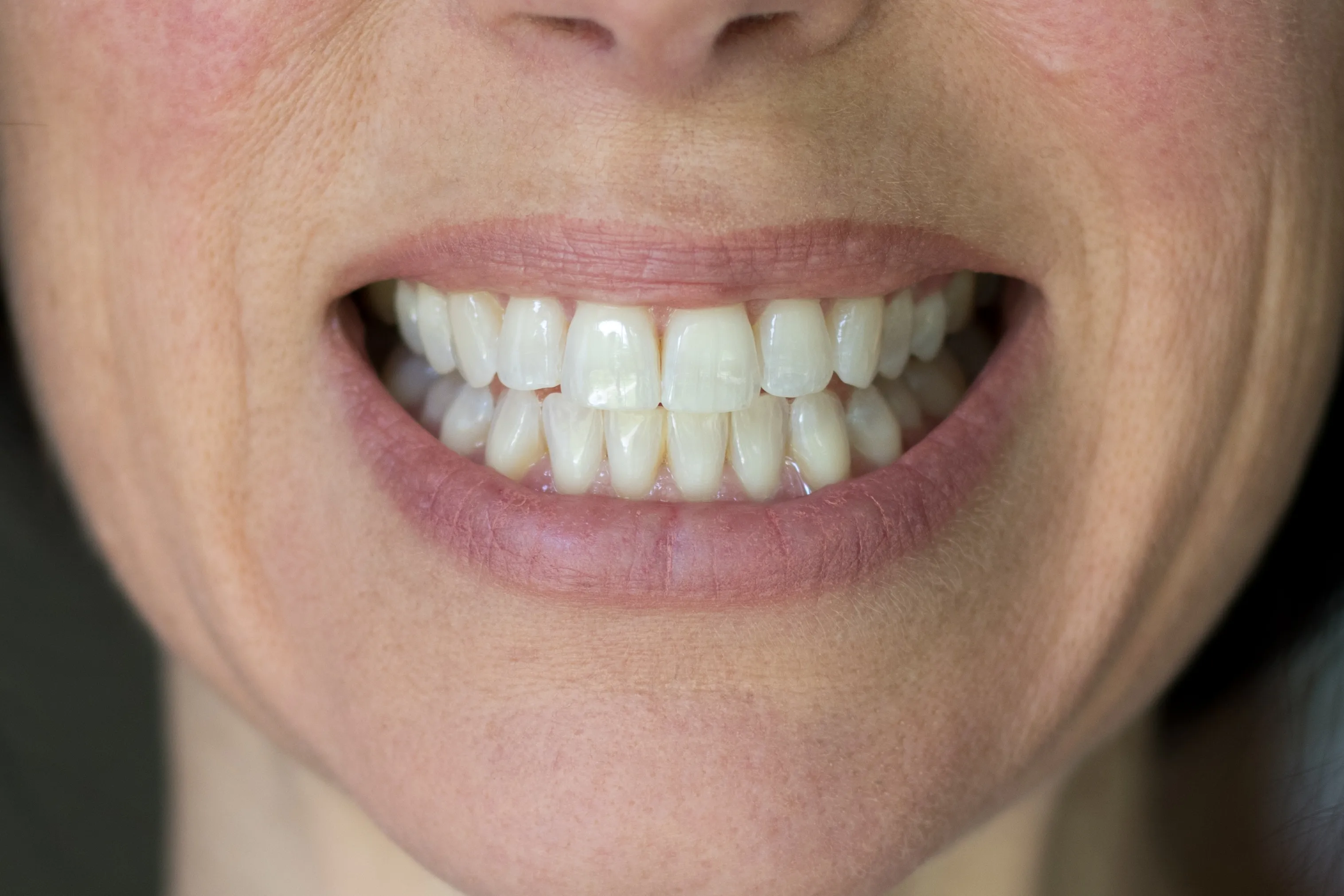 28111 whitening results