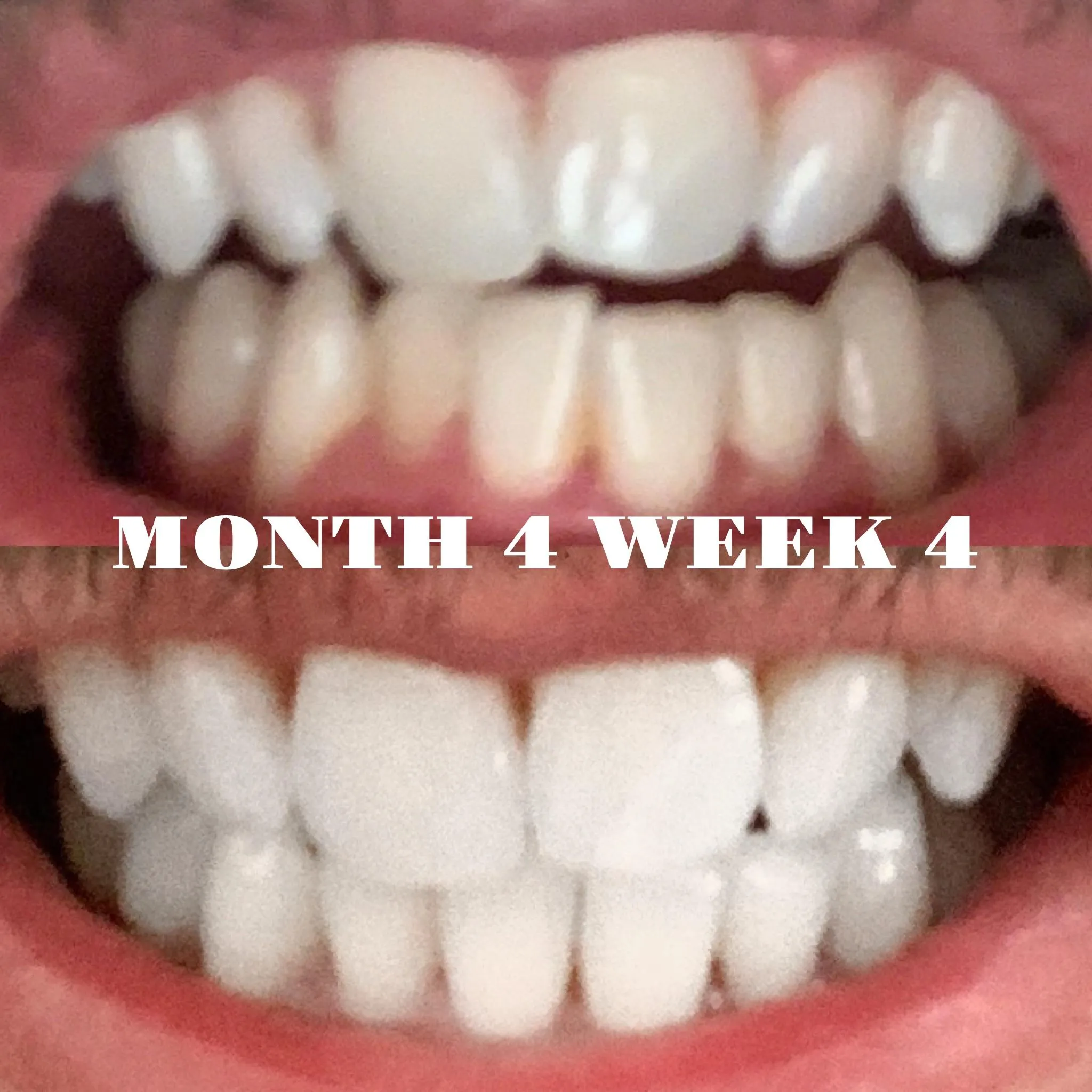 28112 smiledirectclub whitening pros cons