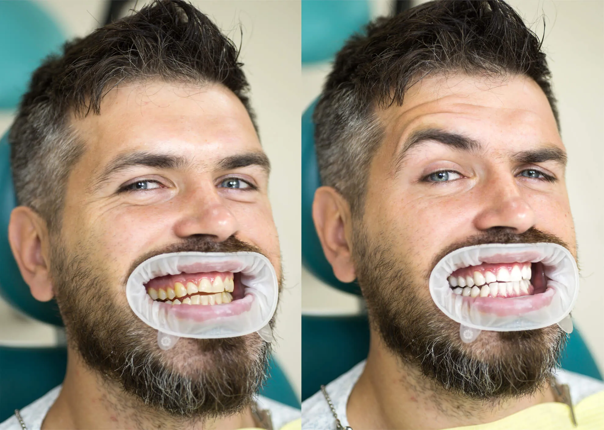 /img/28117-teeth-whitening-before-after.webp