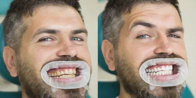 /img/28117-teeth-whitening-before-after.webp
