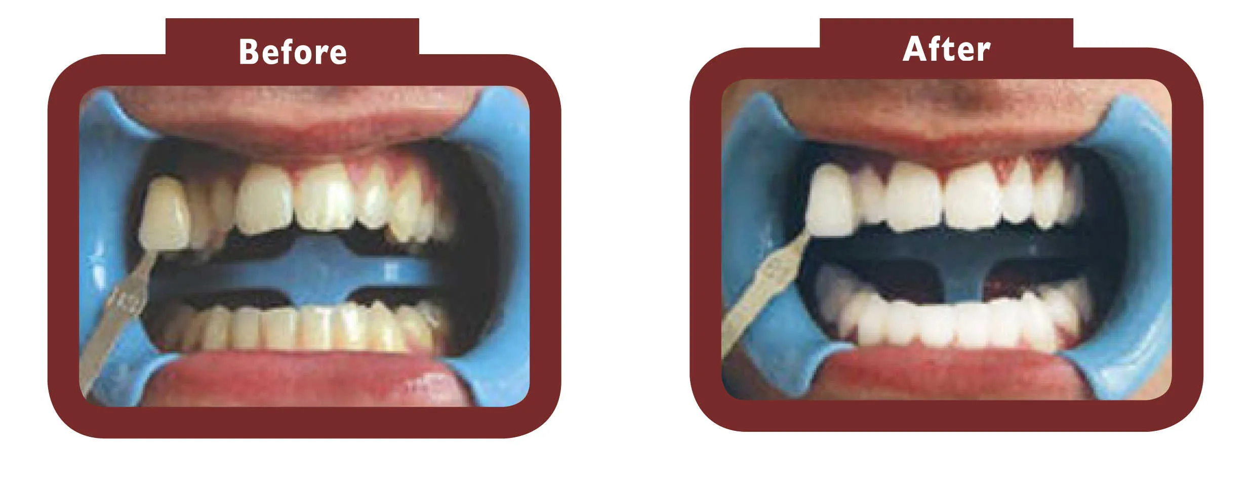 28118 teeth whitening la habra ca process