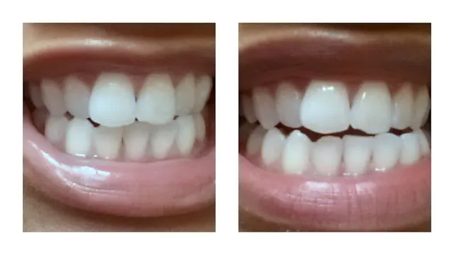 28125 dazzlepro cost comparison