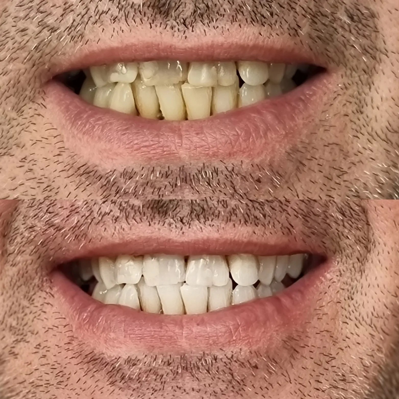 28130 at home teeth whitening