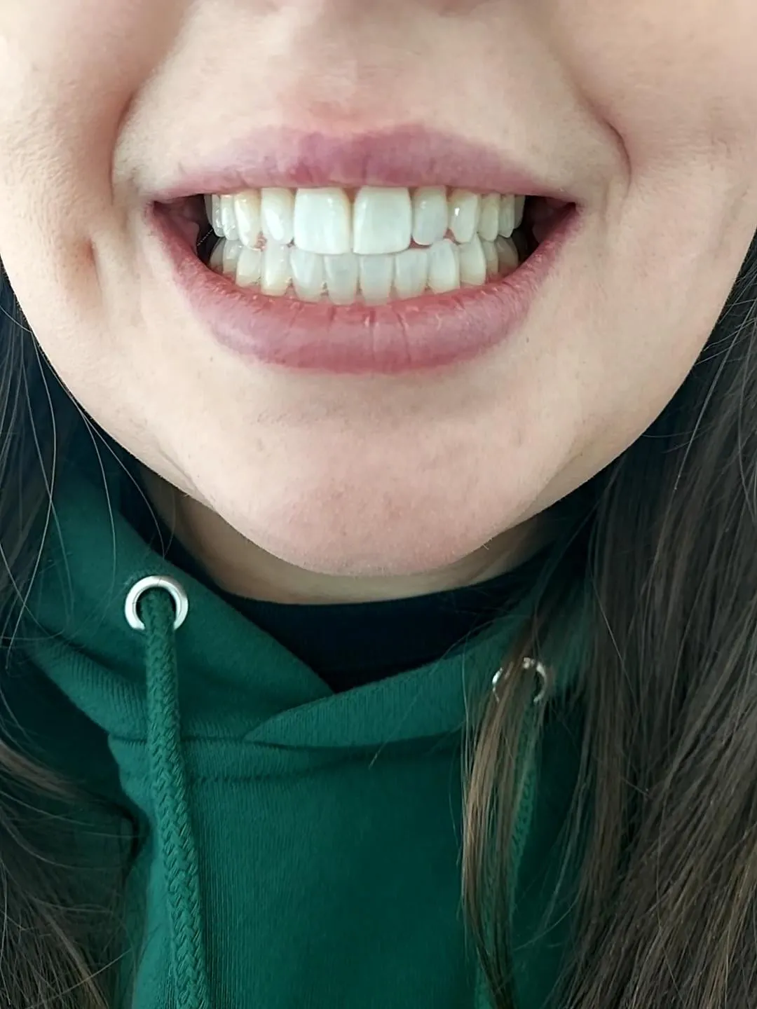 28132 invisalign whitening foods to avoid