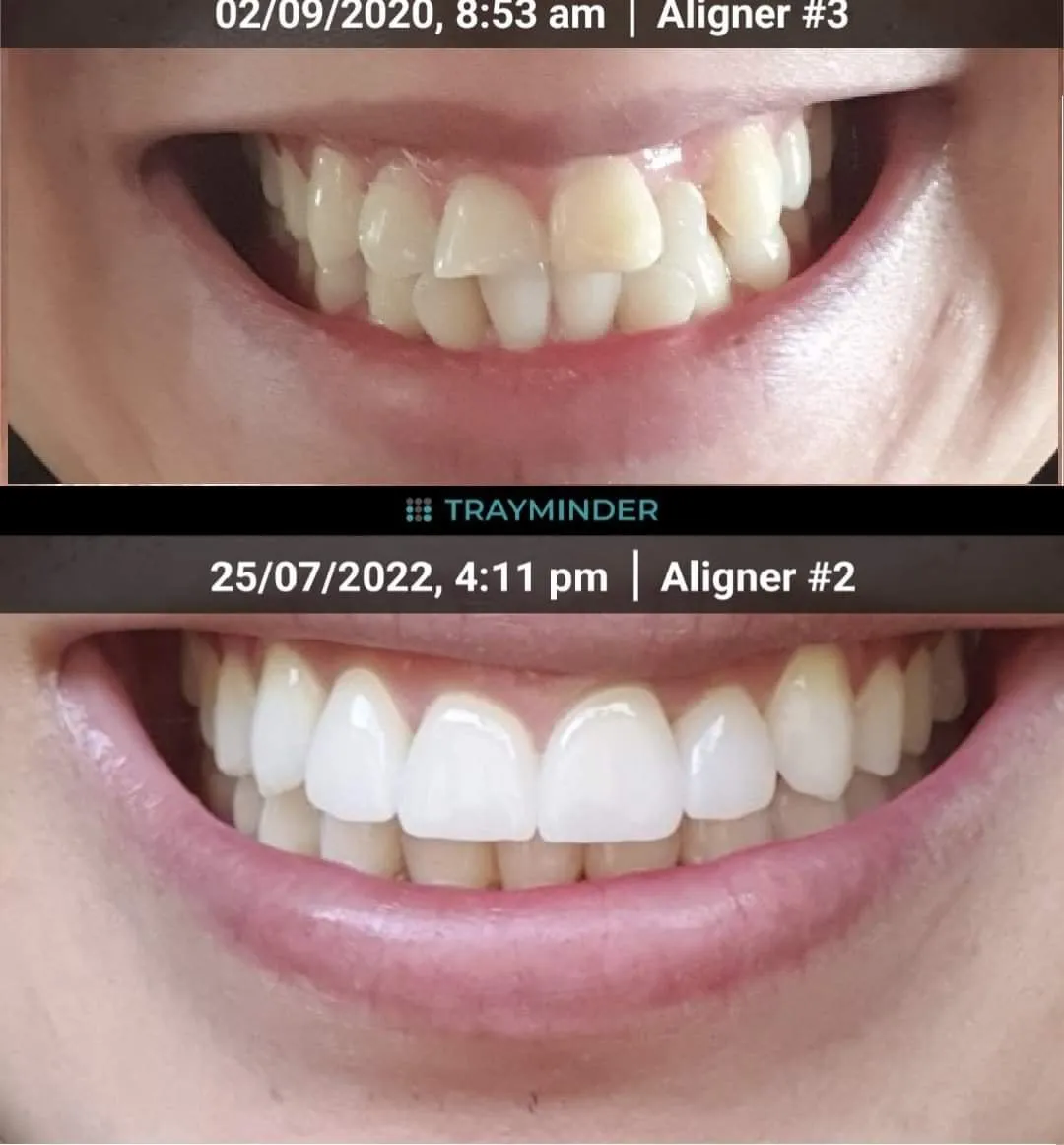 28132 invisalign whitening sensitivity